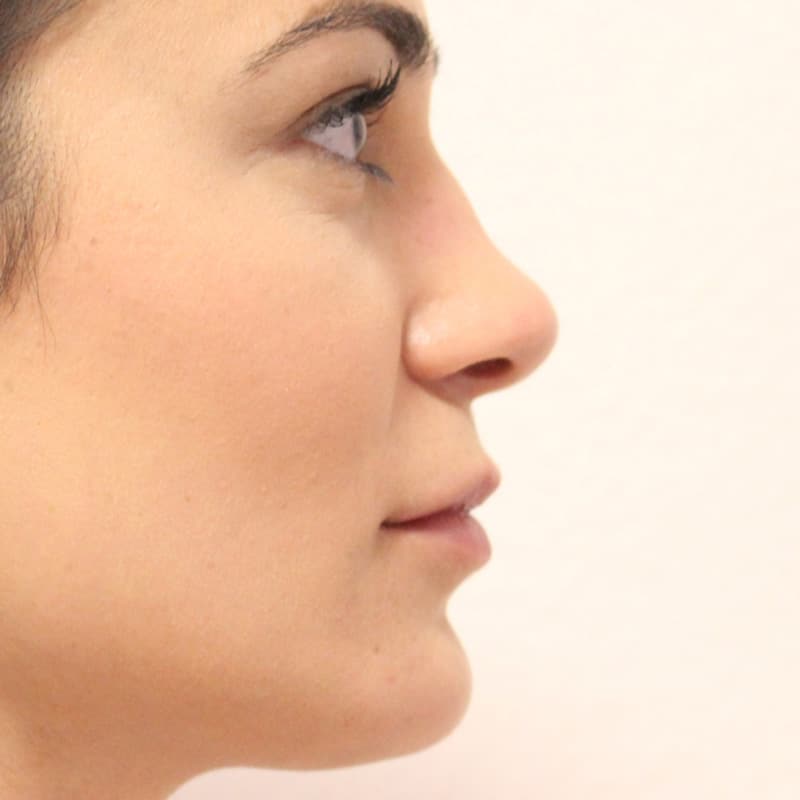 Lip Fillers Basel Switzerland