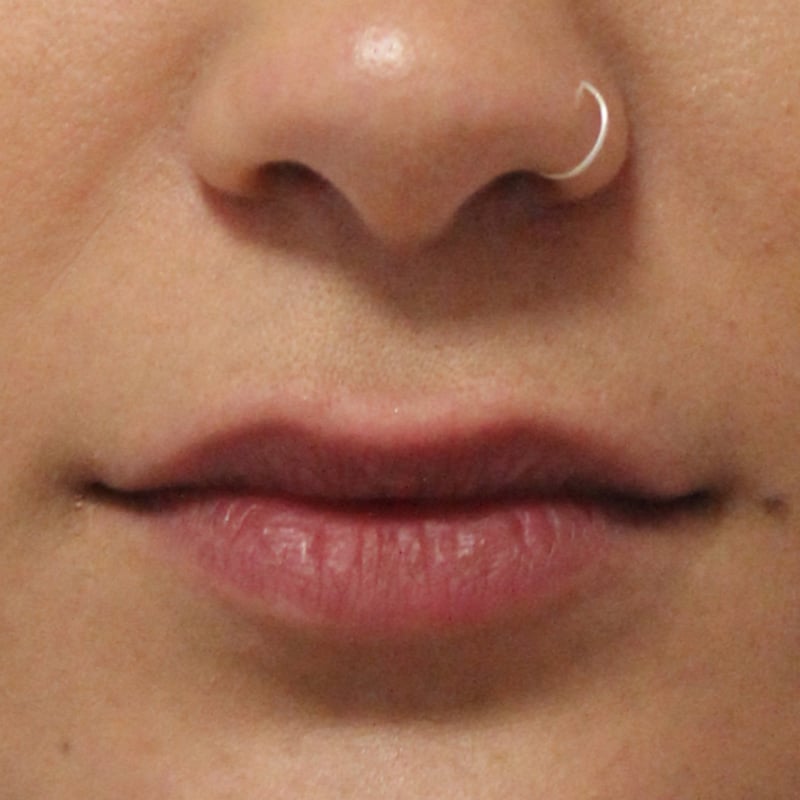 Lip Fillers Basel Switzerland